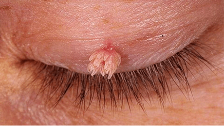 Papiloma