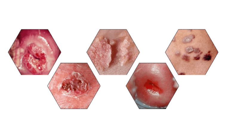 De ce sunt periculoase papiloamele