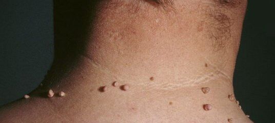 cum să scapi de papiloame