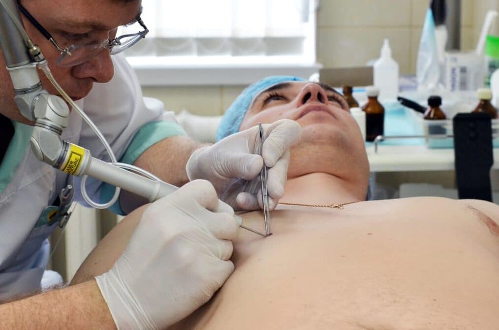 cum să scapi de negi de pe corp