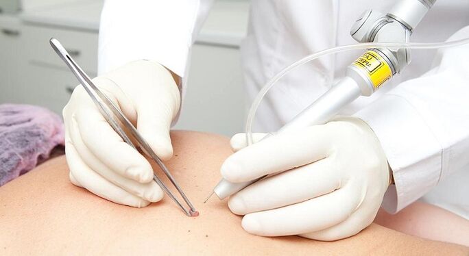 îndepărtarea cu laser a papilomului pentru papilomavirus